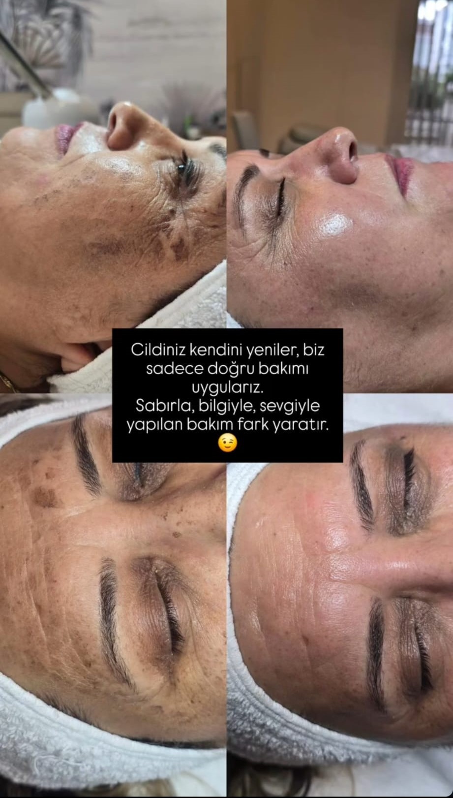 Hydrafacial Cilt Bakımı Samsun Atakum – İstek Lady Güzellik Salonu